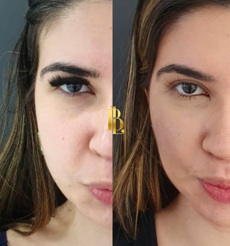 Bichectomia: Antes e depois – Antes da Fama