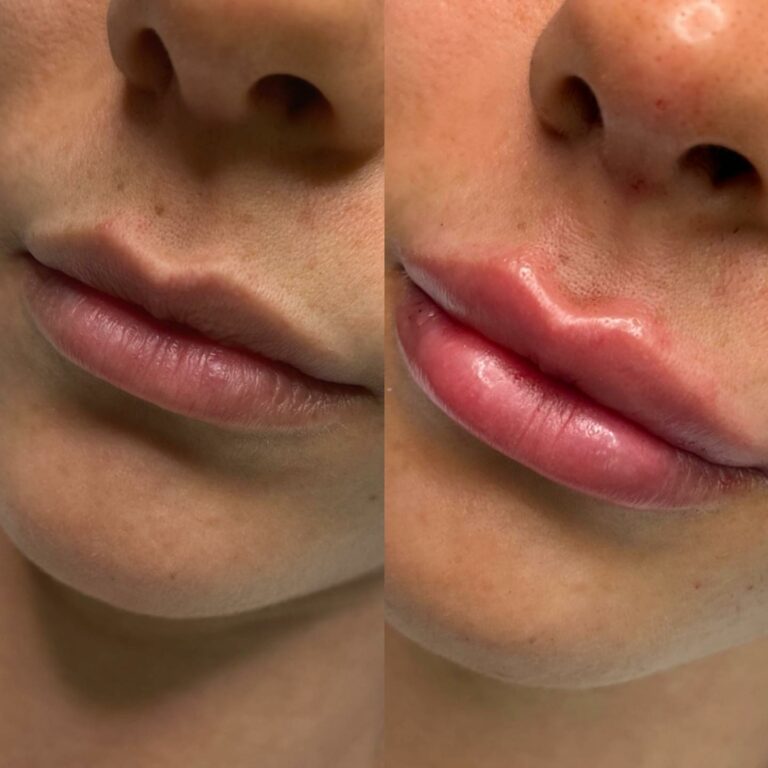 Preenchimento labial: Antes e depois – Antes da Fama