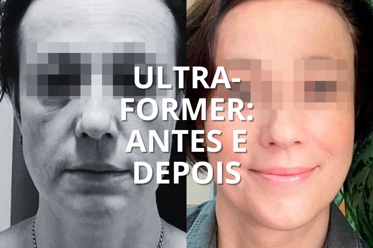 Tratamento com Plasma no rosto: Antes e depois – Antes da Fama